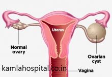 ovarian-cyst