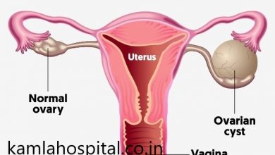 ovarian-cyst