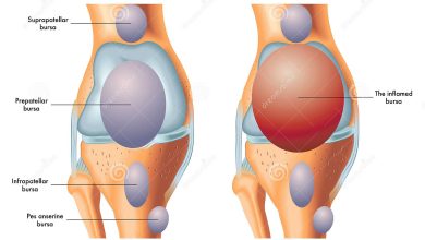 Suprapatellar-Bursa-Causes-Treatments