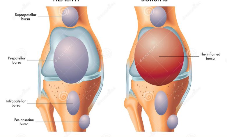 Suprapatellar-Bursa-Causes-Treatments