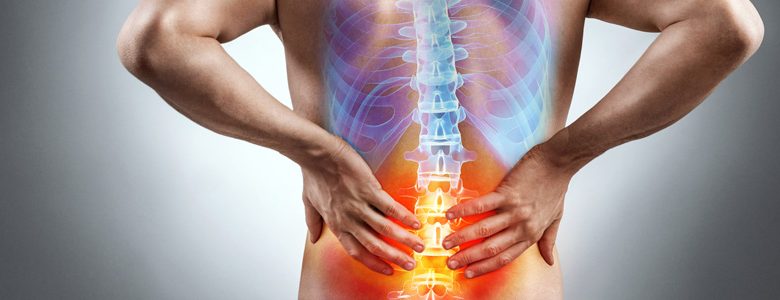 Sciatica