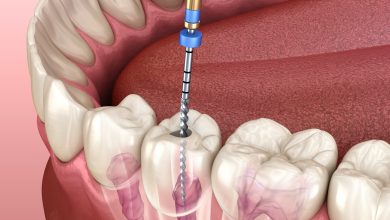 Can a Root Canal Fail?